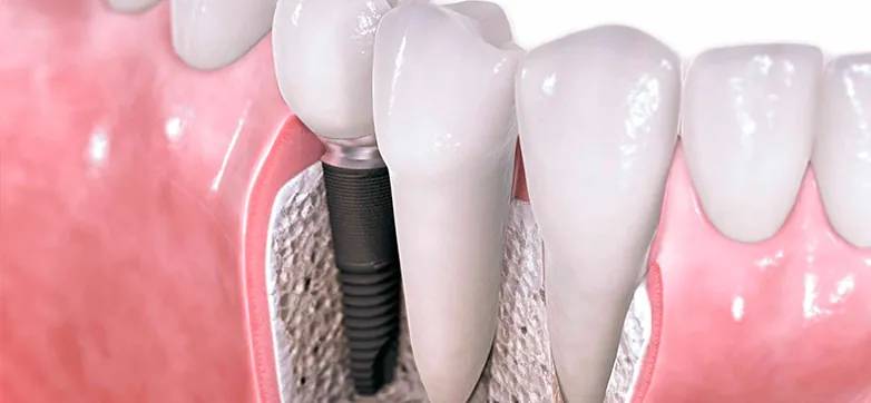 Dental implants