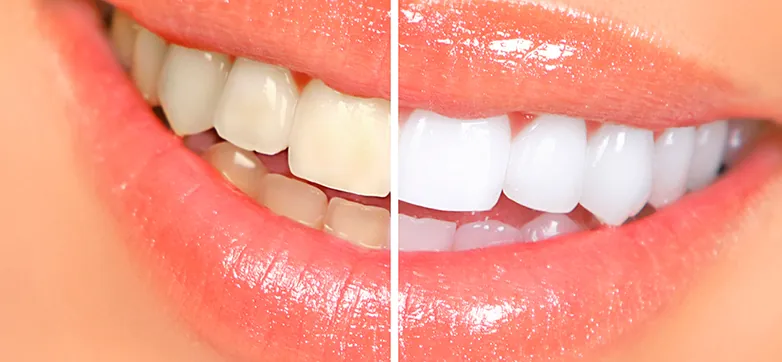 Teeth whitening
